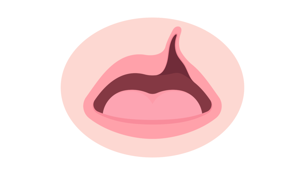 cleft lip & palate children