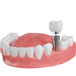 dental implants